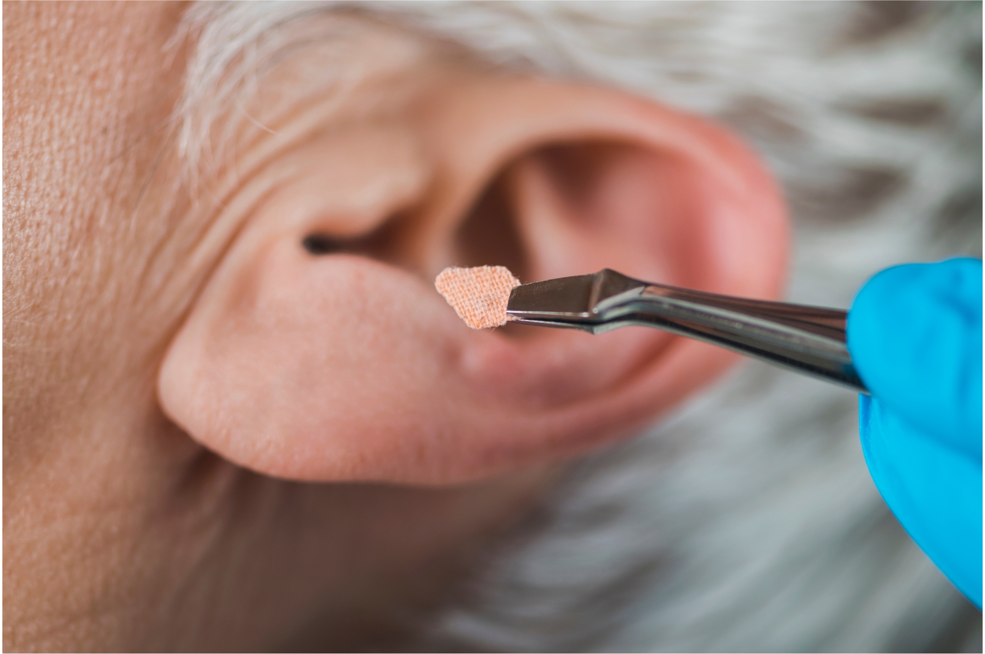 Oreja de mujer mayor recibiendo acupuntura estética auricular.