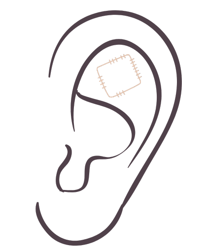 Icono de una oreja con un parche de auriculoterapia, tratamiendo de acupuntura estética.
